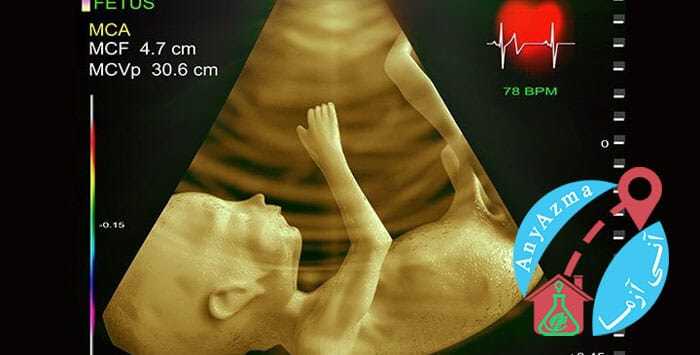 آزمایش غربالگری بارداری مرحله اول