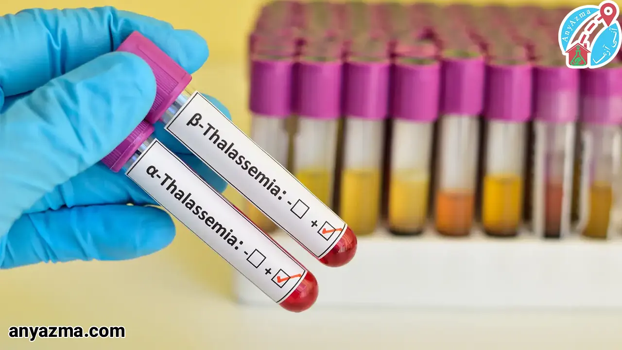 علت ابتلا به تالاسمی چیست