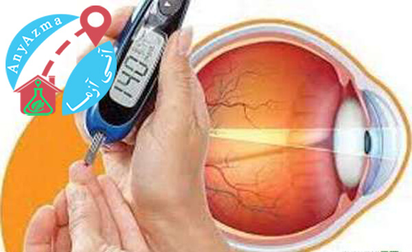 سلامت چشم در دوران دیابت