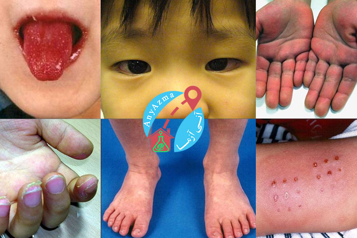 بیماری کاوازاکی در کودکان و ارتباط آن با ویروس کرونا