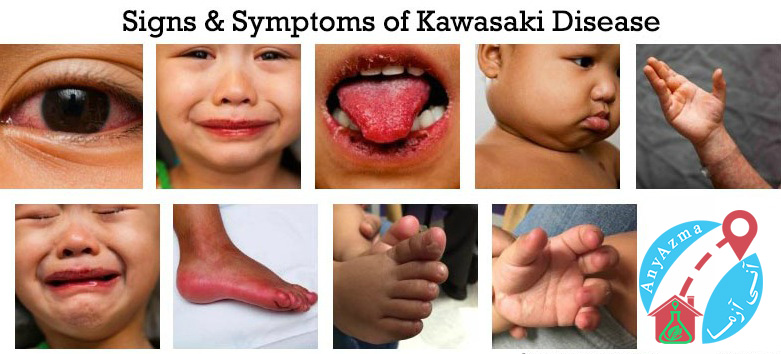 بیماری کاوازاکی در کودکان و ارتباط آن با ویروس کرونا