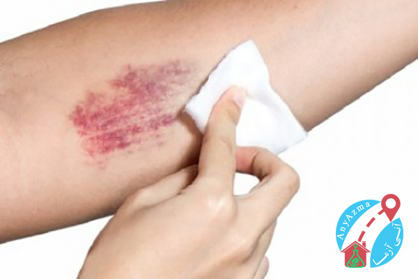 علت کبودی دست بعد از خونگیری چیست؟