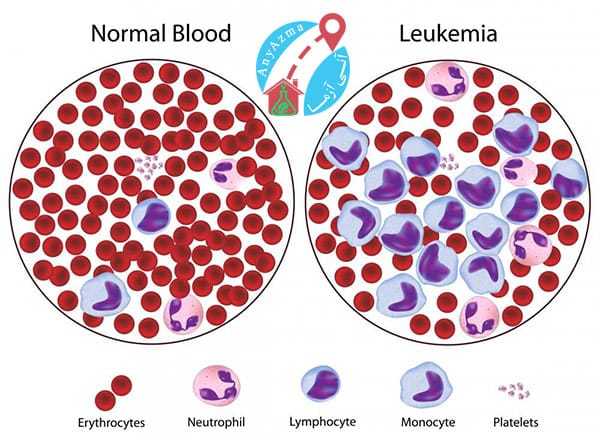 آنچه باید درباره ی بیماری لوسمی بدانید