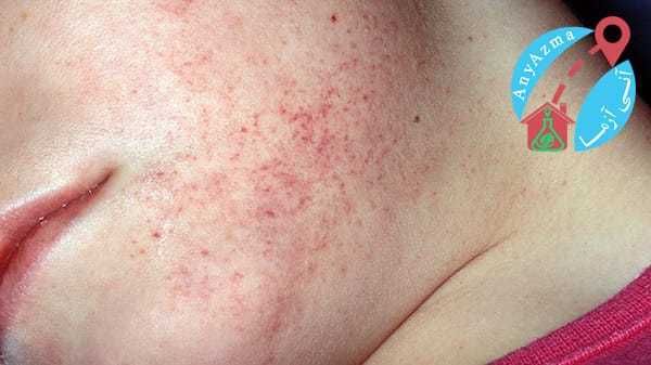 آنچه باید درباره ی بیماری لوسمی بدانید