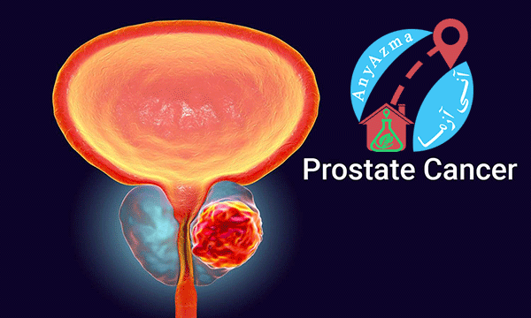 سرطان پروستات چیست و چگونه تشخیص داده می شود