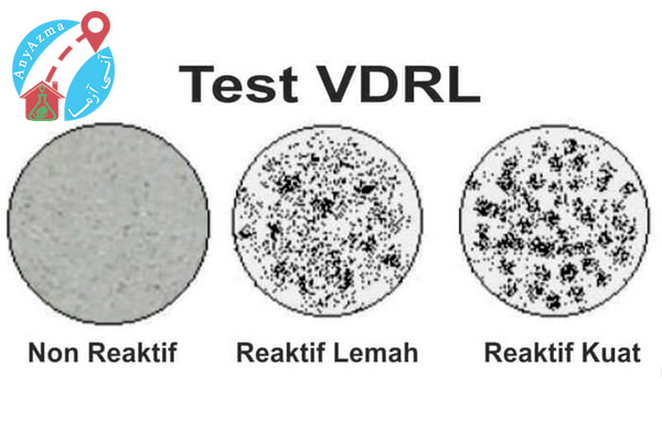 آزمایش تشخیص سفیلیس ( VDRL)