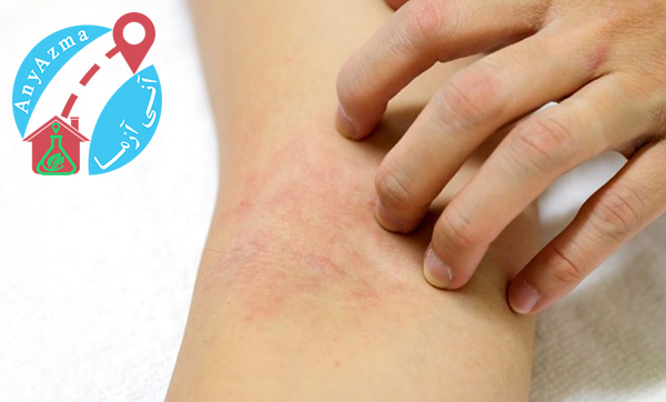 علائم پوستی کرونا چیست؟