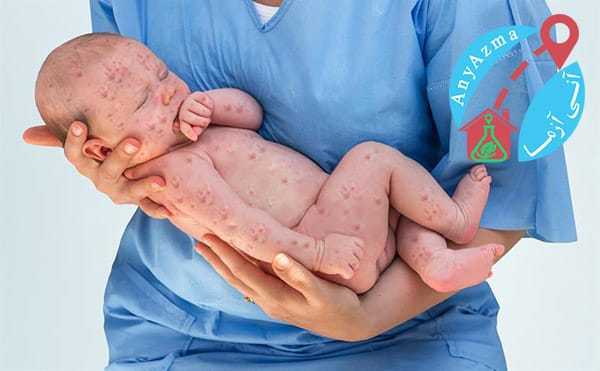 هر آن چه که باید در مورد سرخچه بدانیم
