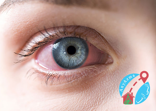 چشم صورتی و علائم چشمی COVID-19 چیست؟