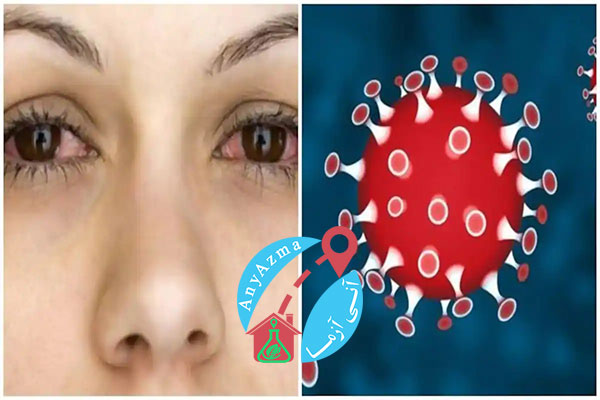 عفونت چشم (التهاب ملتحمه) در اثر کرونا