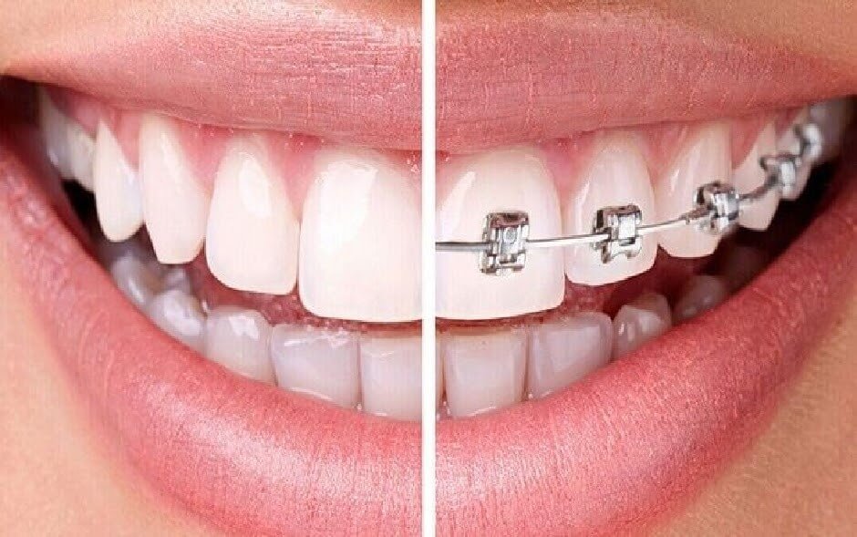 ارتودنسی دندان ها دندانپزشکی آتن