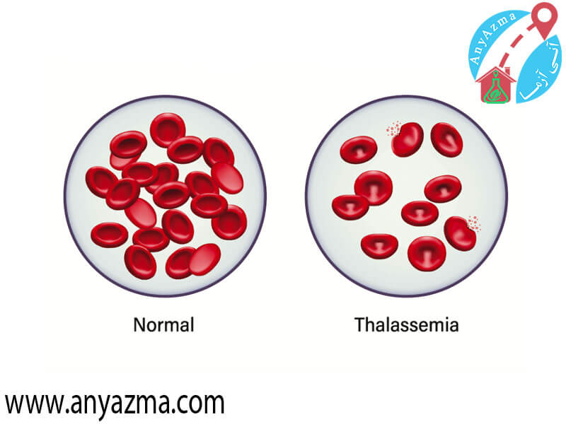 تالاسمی نوعی کم خونی یا اختلال خونی ژنتیکی و ارثی است