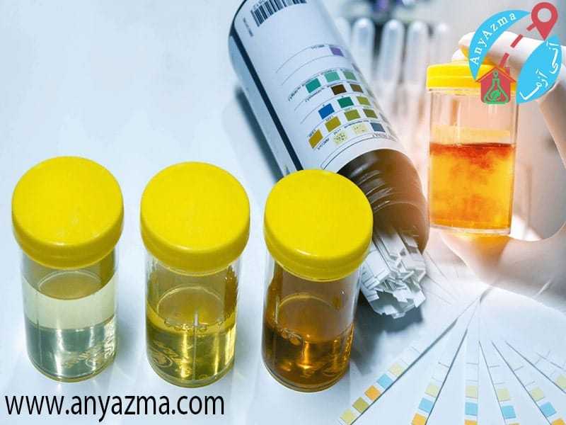انواع نمونه های ادرار و تفاوت واضح در رنگ نمونه ها
