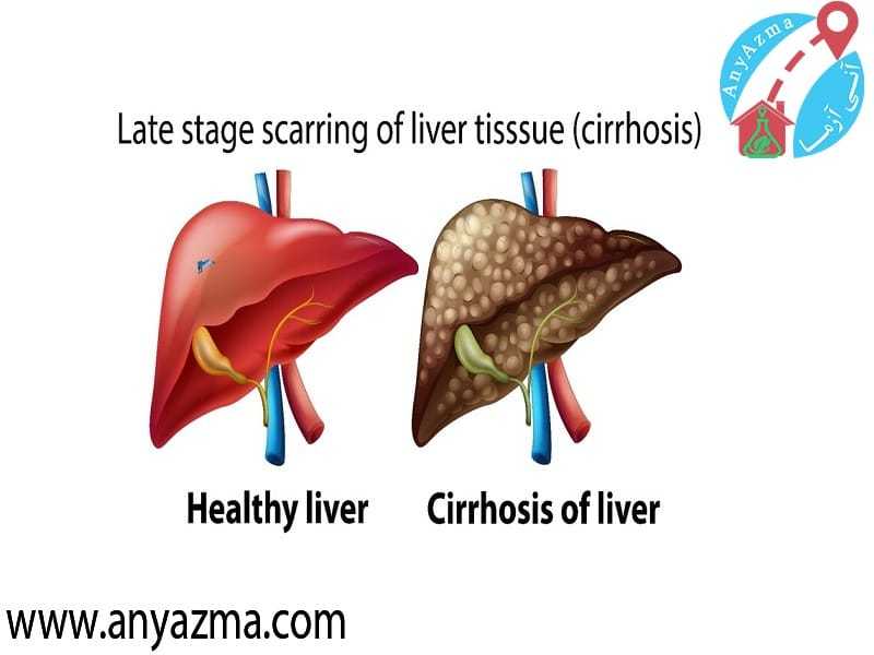 علامت اختصاری کبد چرب در آزمایش و گرید کبد چرب در آزمایش خون