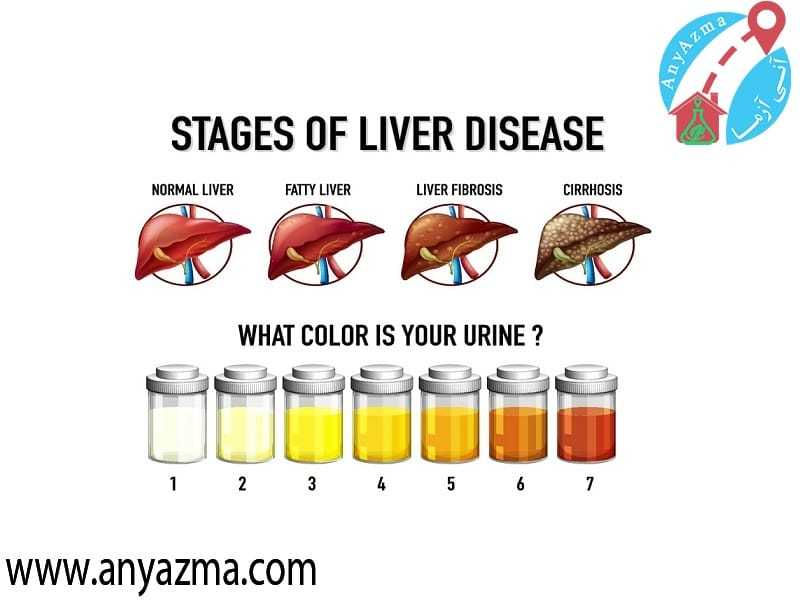 آزمایش کبد چرب و راهنمایی برای شناخت سلامت کبد