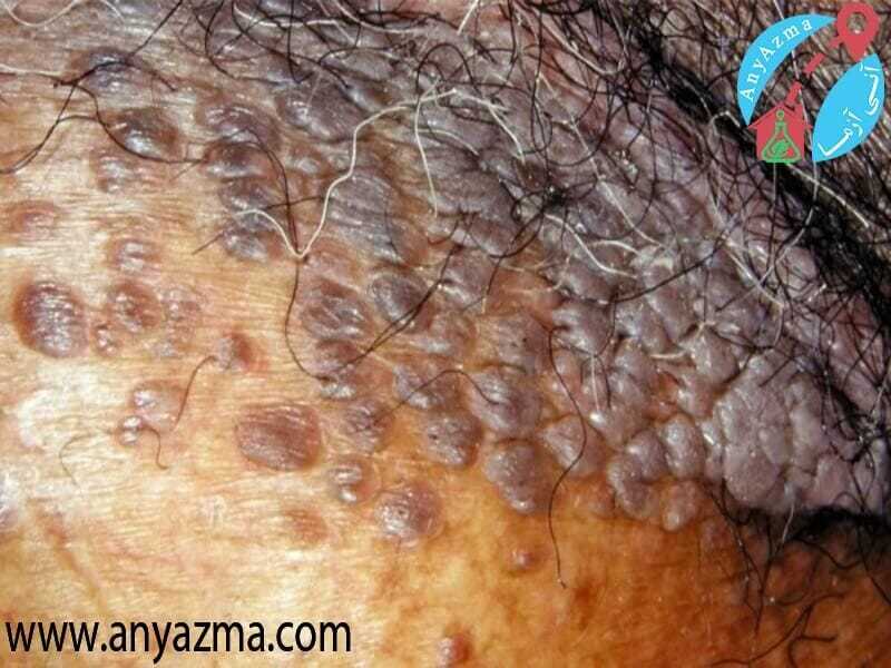 تفاوت شکل زگیل تناسلی در زنان