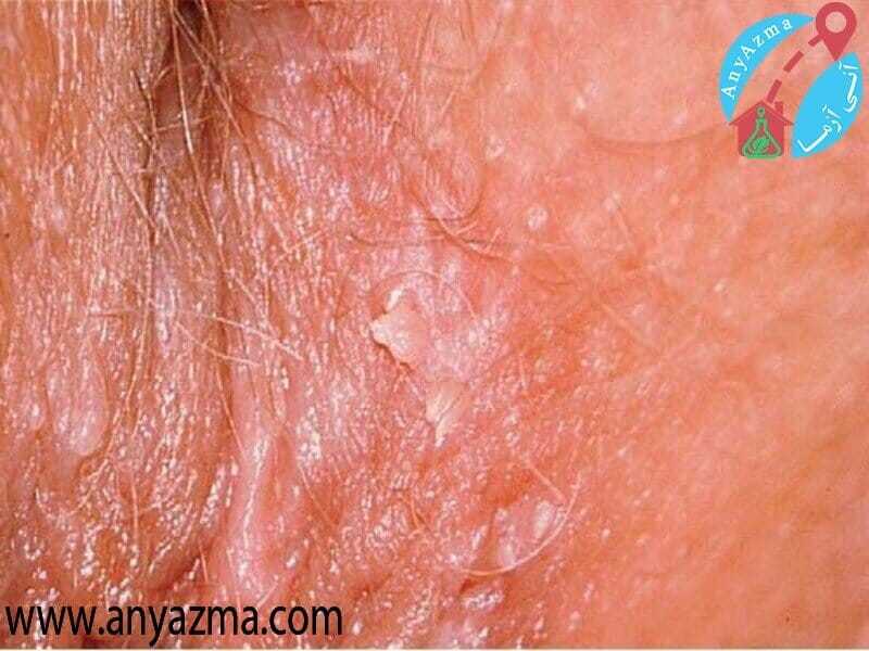 درمان زگیل تناسلی در خانم ها