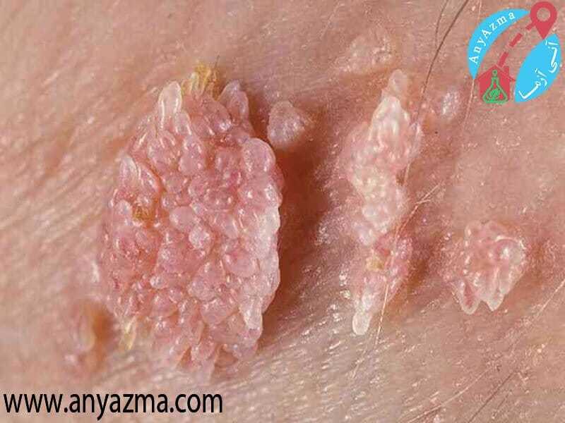 علائم مهم زگیل تناسلی زنان