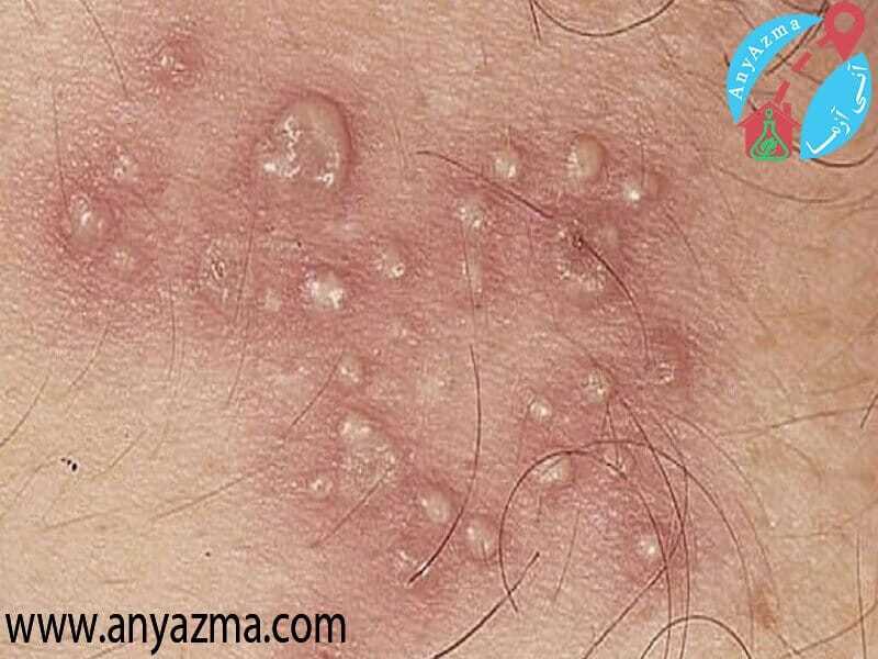 شکل زگیل تناسلی در زنان