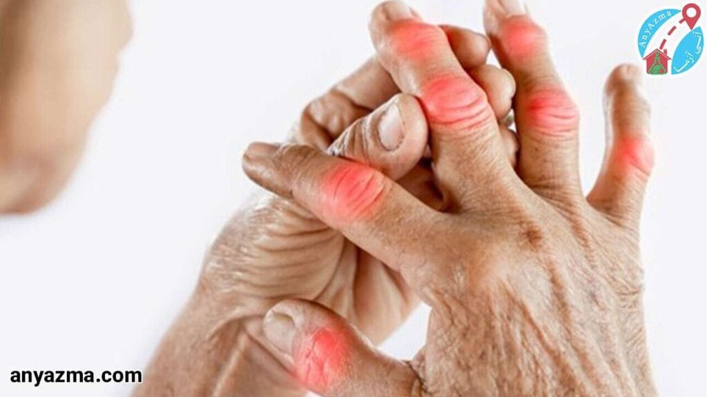 تفاوت بین آرتریت روماتوئید و سایر بیماری‌های التهابی