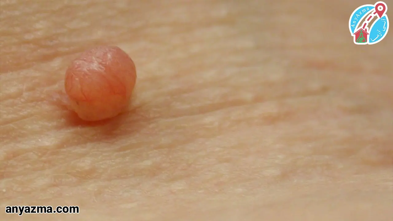 تفاوت HPV با زگیل تناسلی