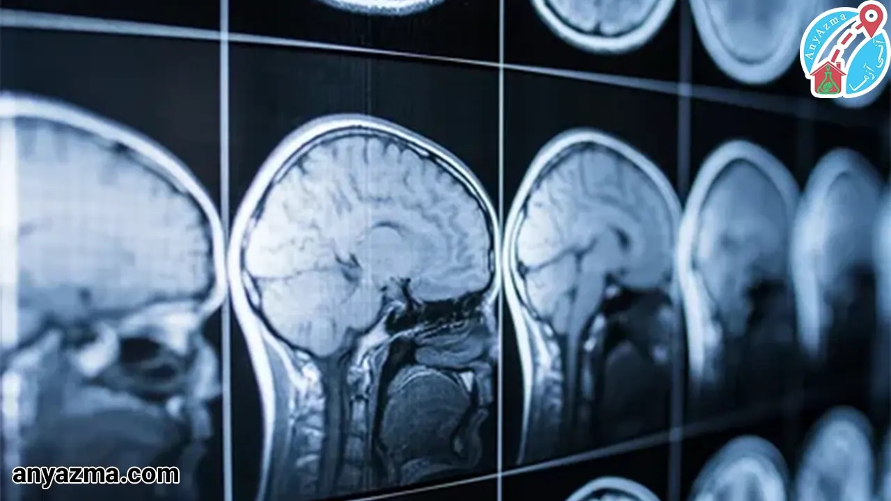 نحوه خواندن نتایج نوار مغز