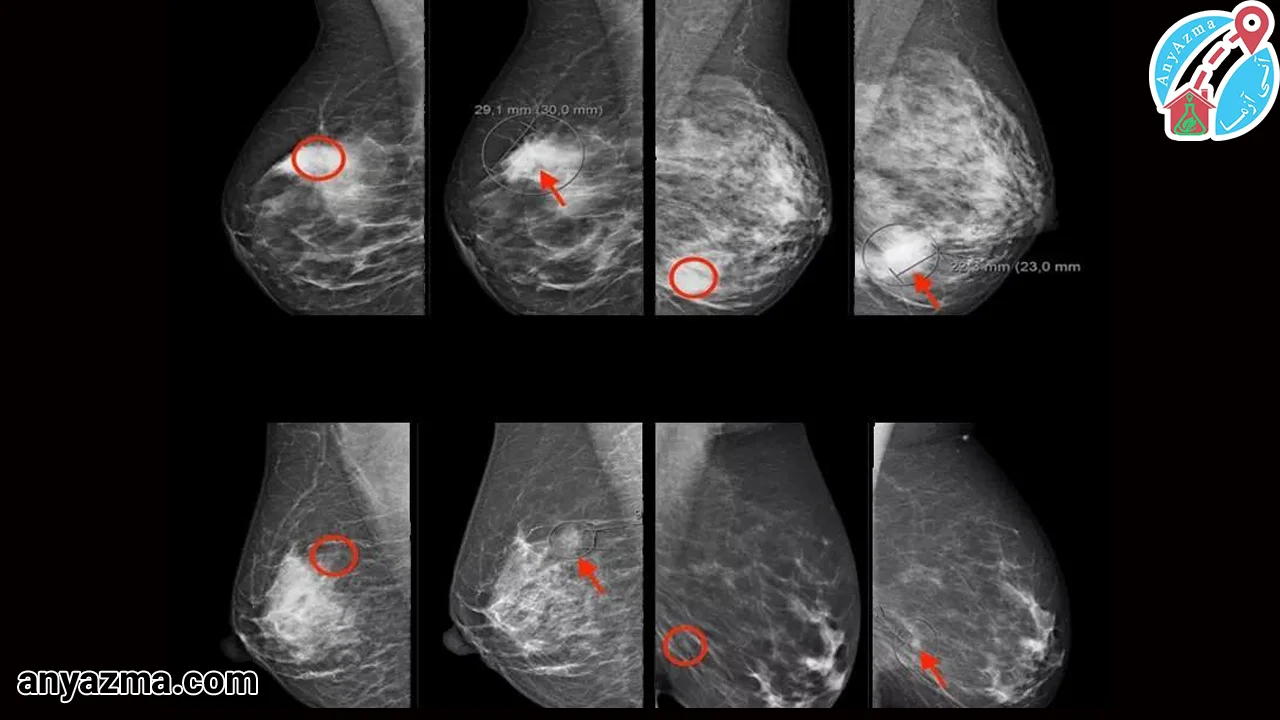تشخیص سرطان سینه با سونوگرافی