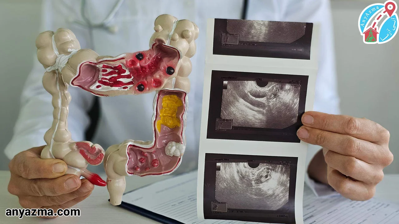 روش های تشخیص سرطان روده