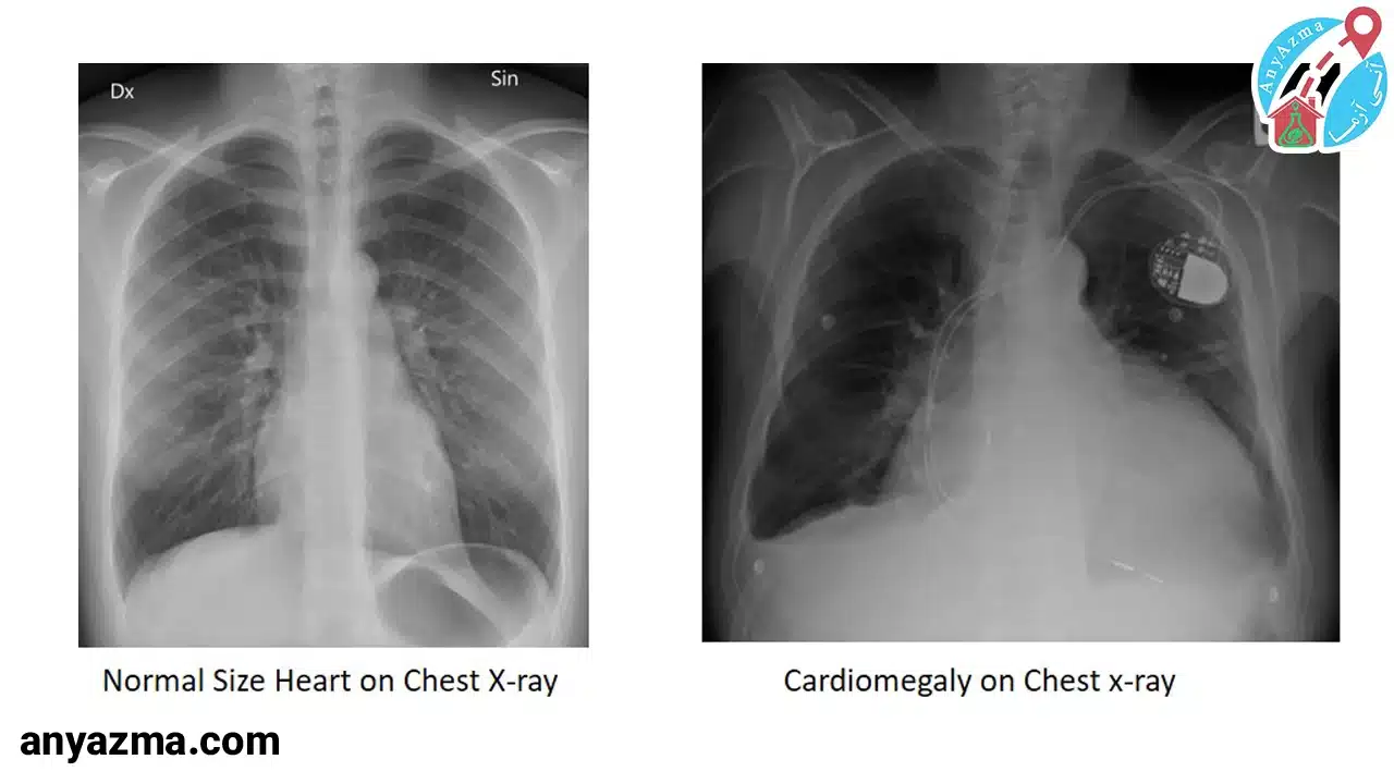 آیا بزرگ شدن قلب باعث مرگ میشود؟