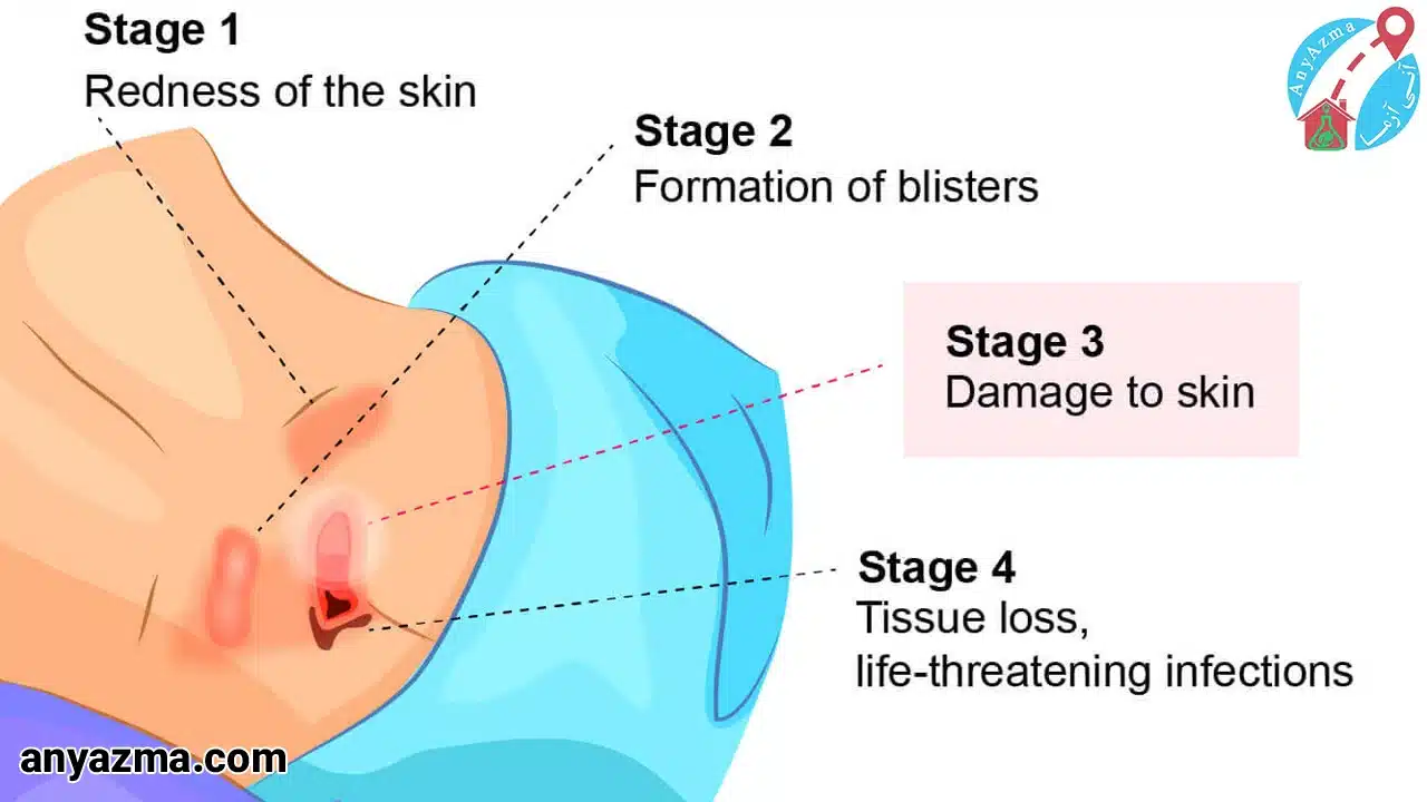 درمان زخم بستر در منزل