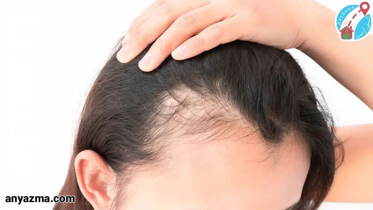 علائم ریزش مو در کم کاری تیروئید