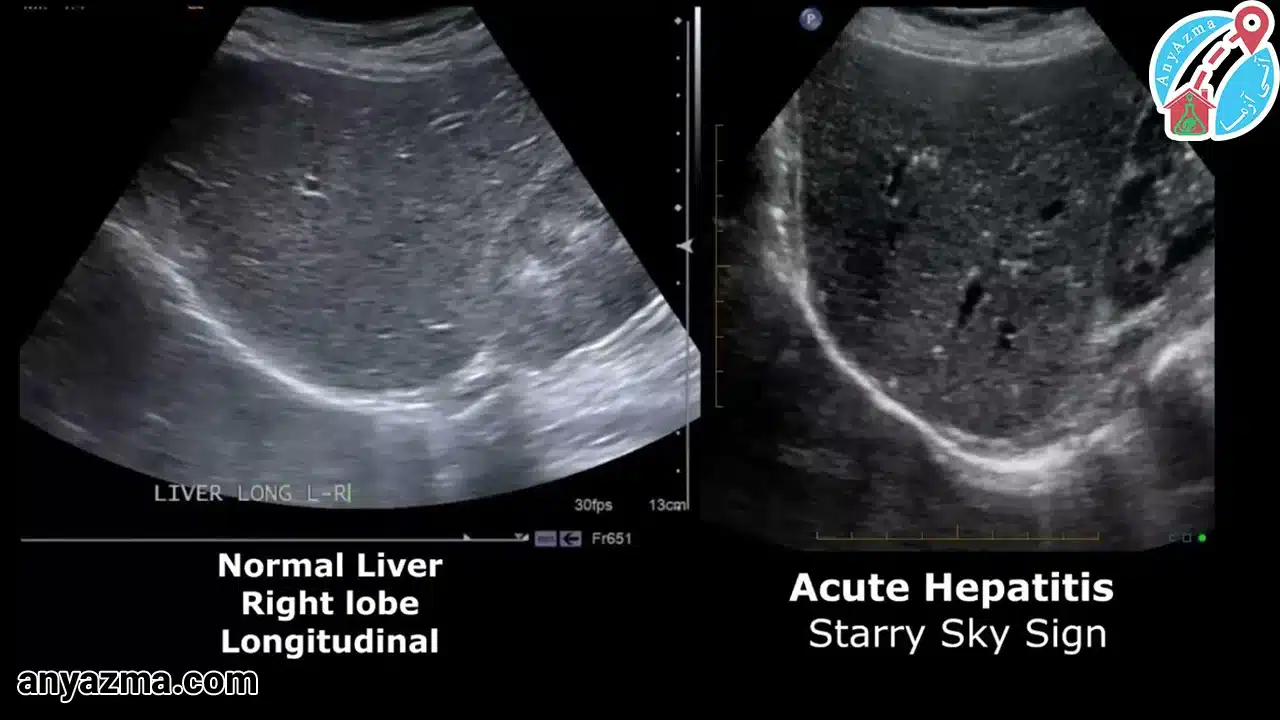 خواندن برگه سونوگرافی کبد