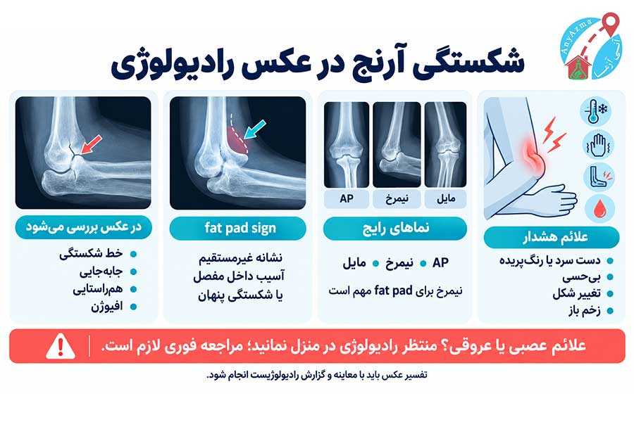 اینفوگرافی شکستگی آرنج در عکس رادیولوژی