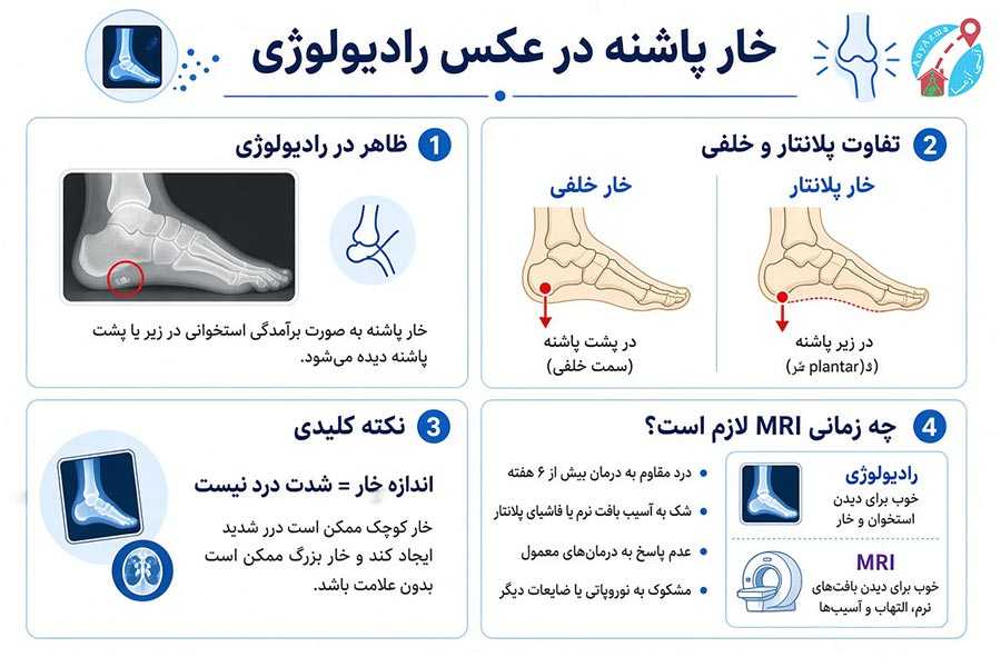 اینفوگرافی عکس رادیولوژی خار پاشنه