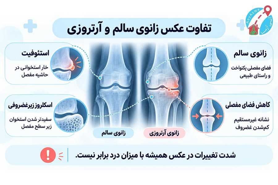تفاوت عکس زانوی آرتروزی و سالم