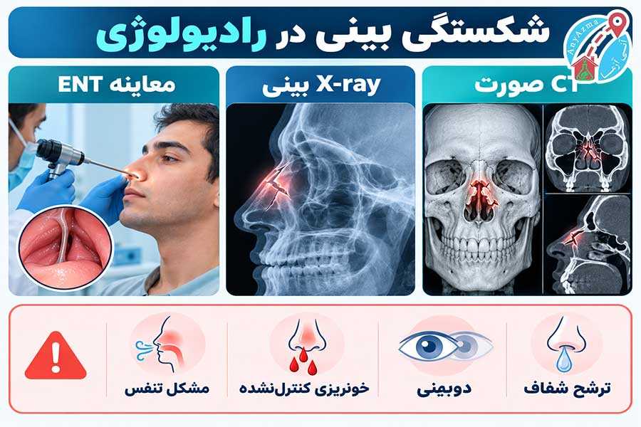 اینفوگرافی شکستگی بینی در رادیولوژی